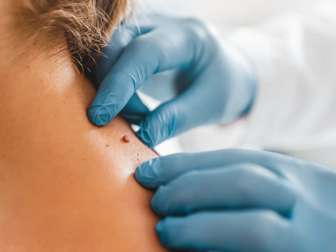 Wart and skin tag removal at LetMein Beauty, Angeles City