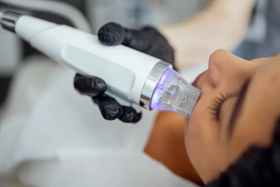 RF microneedling skin treatment at LetMein Beauty, Angeles City